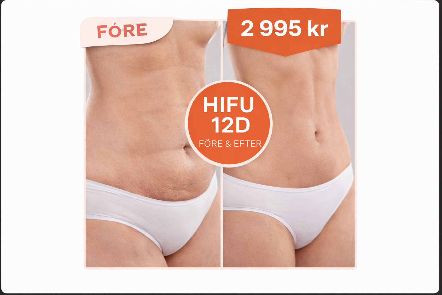 HIFU 12D Sculpt SlimLift – Klippkort (2 behandlingar)