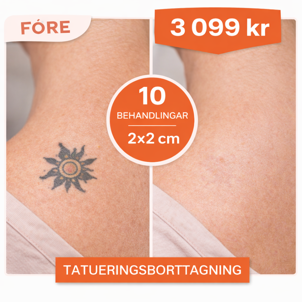 Paketbehandlingar för borttagning av mindre tatueringar upp till 2×2 cm med Nd:YAG-laser.