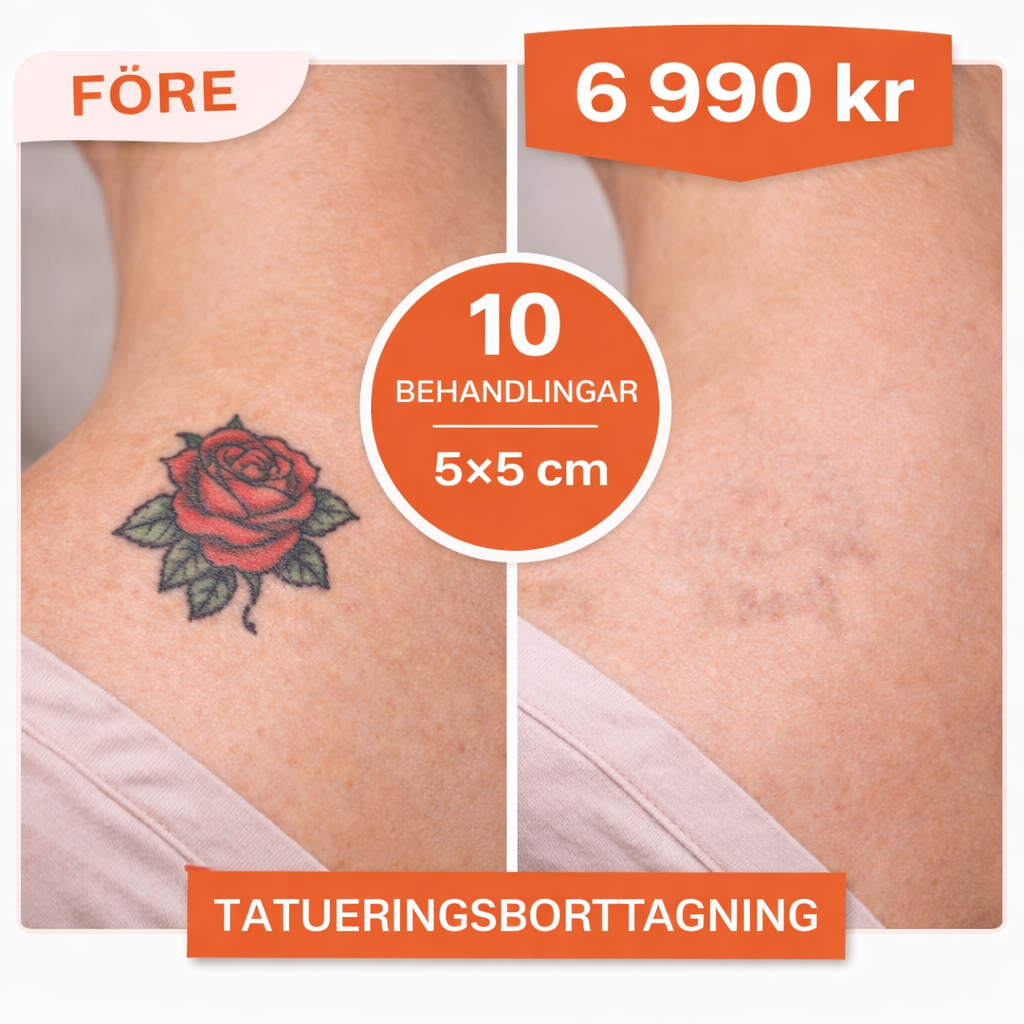 Tatueringsborttagning – 5×5 cm Paketbehandlingar (10 sessioner)