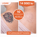 Laserbehandling för tatueringspigment 10×10 cm i Stockholm (Östermalm) – Paket 10