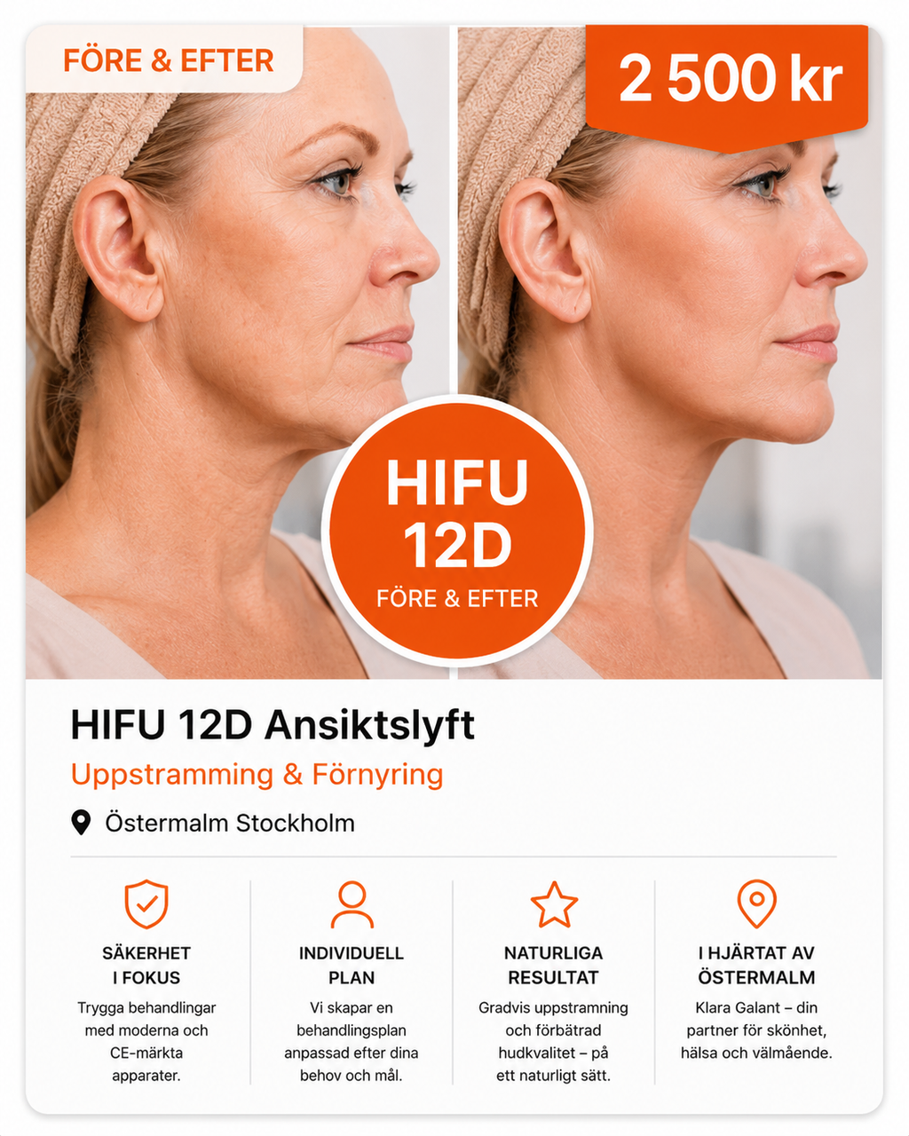 HIFU 12D Ansiktslyft i Stockholm – Uppstramning & Föryngring